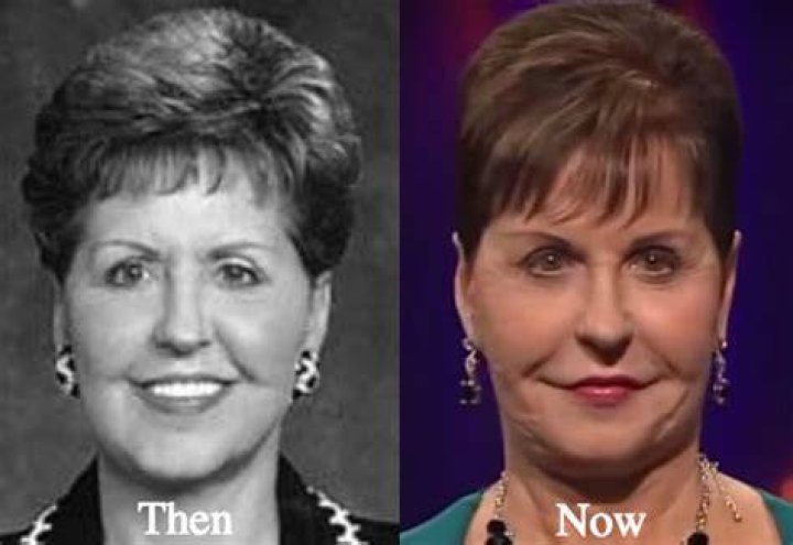 Photo Of Joyce Meyers Before Plastic Surgery